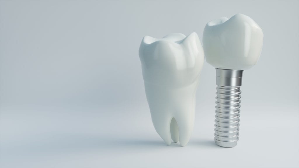 Model of human molar complete, model of similar molar with titanium screw replacing root